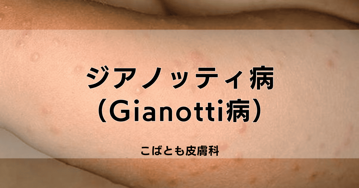 ジアノッティ病（Gianotti病）