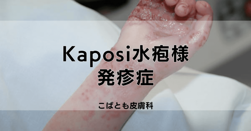 Kaposi水疱様発疹症