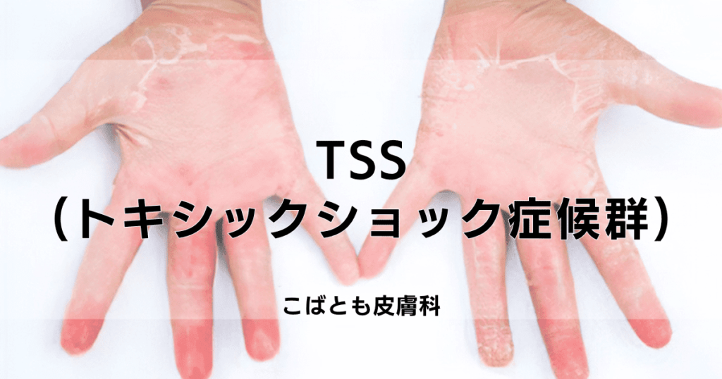 TSS（トキシックショック症候群）