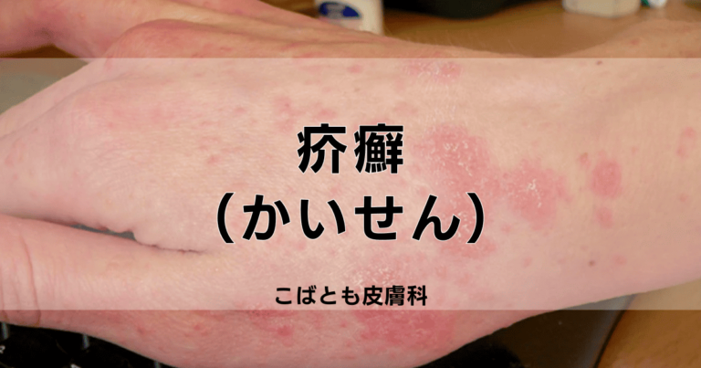 疥癬 かいせん 写真 _ 疥癬ダニはどのように見えますか – 疥癬(かいせん) Q5 – TZTAJ