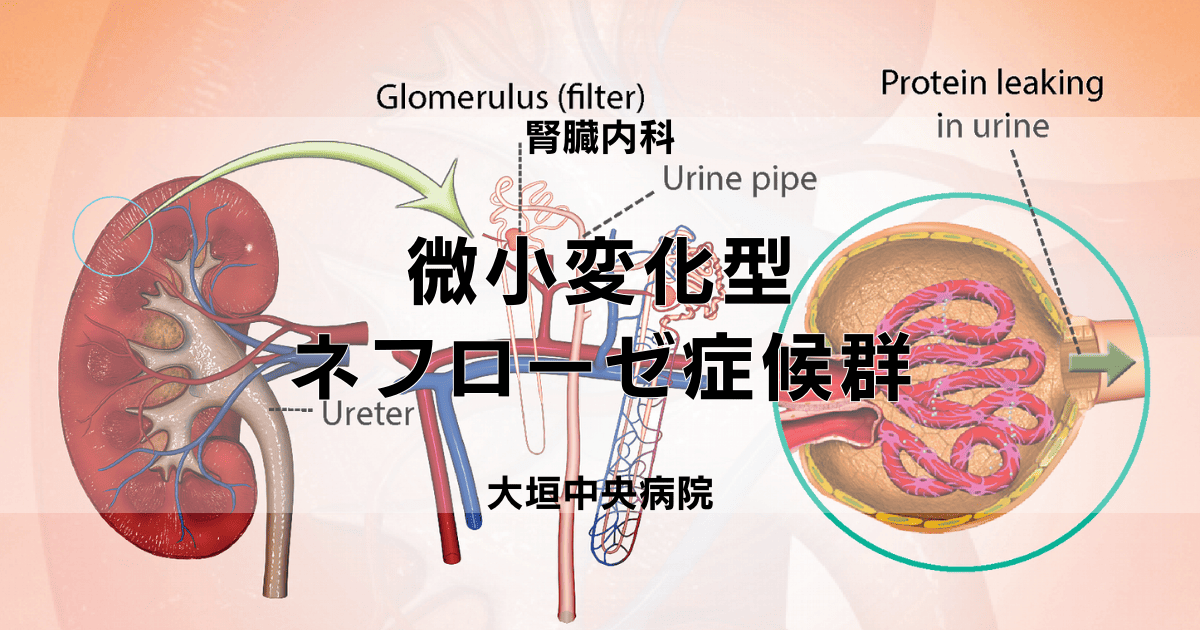 微小変化型ネフローゼ症候群（MCNS）