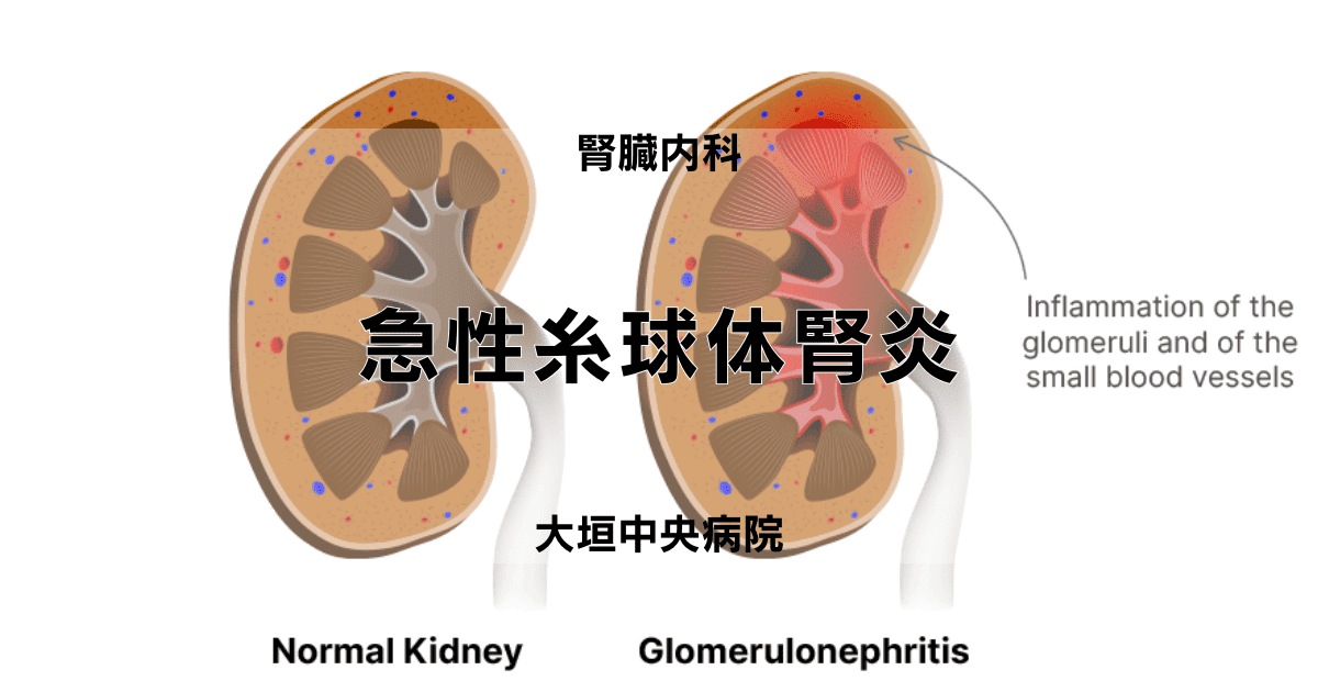 急性糸球体腎炎