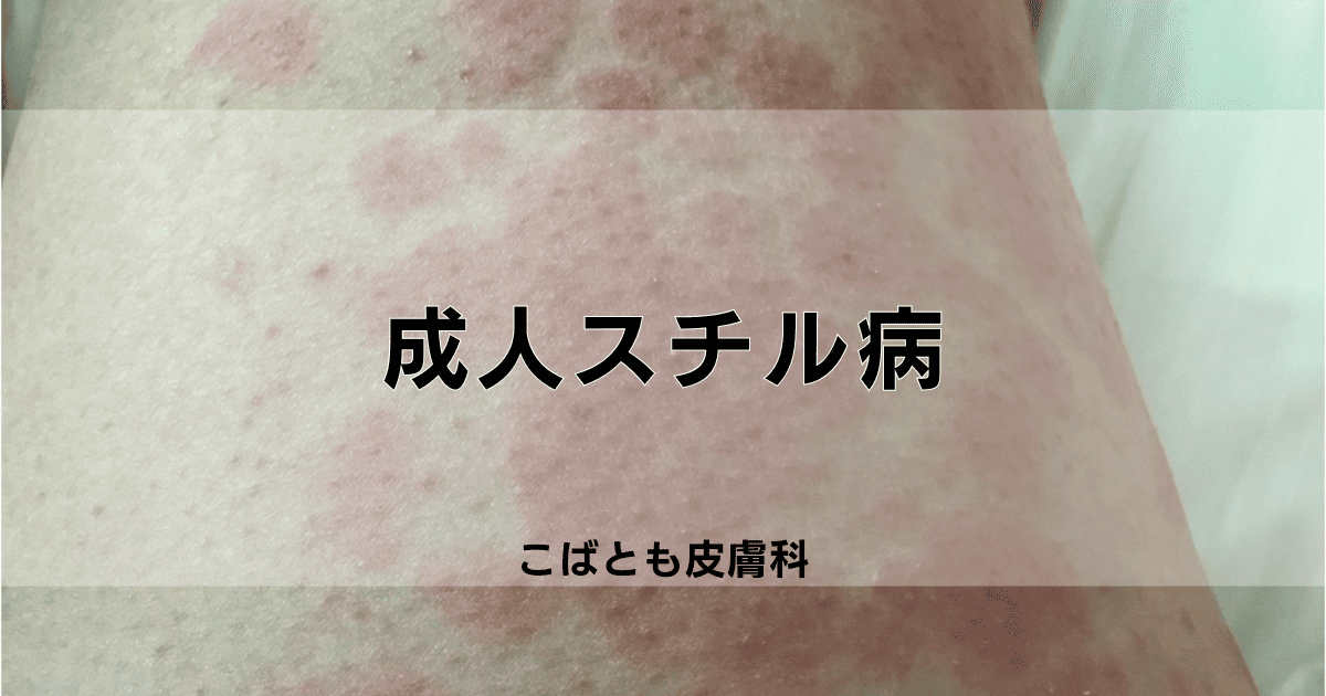 成人スチル病