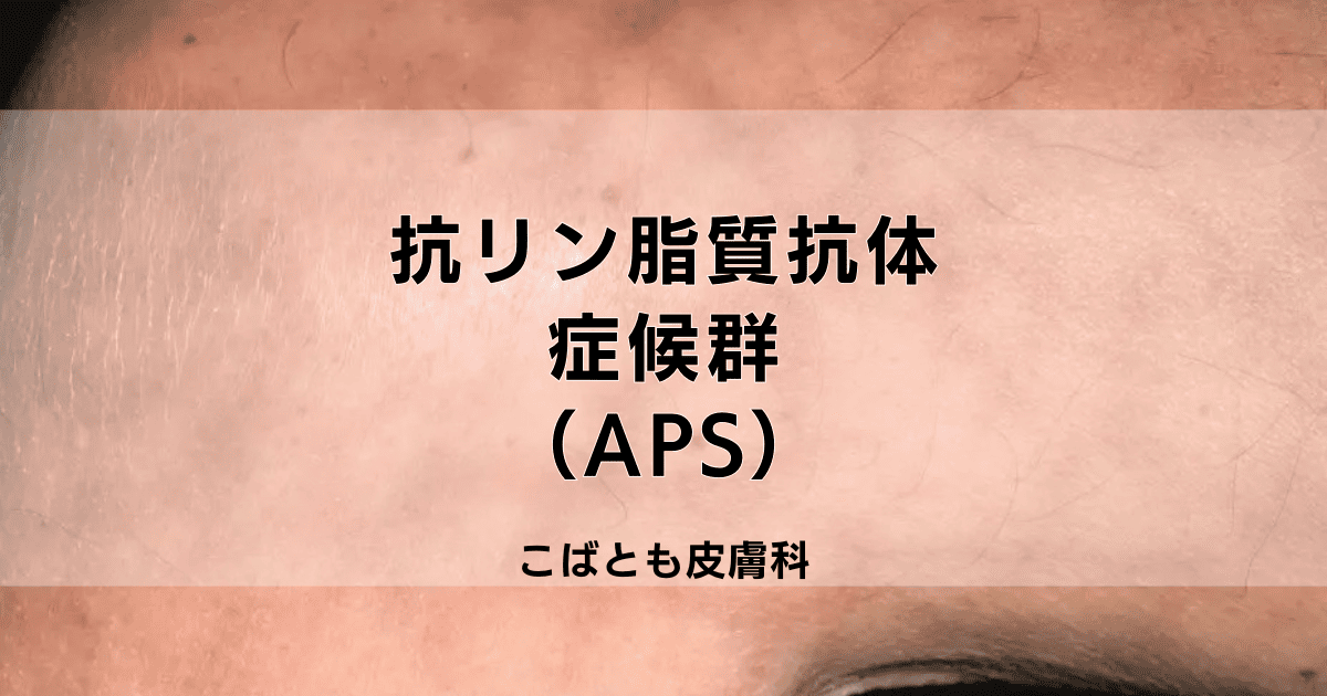 抗リン脂質抗体症候群（APS）