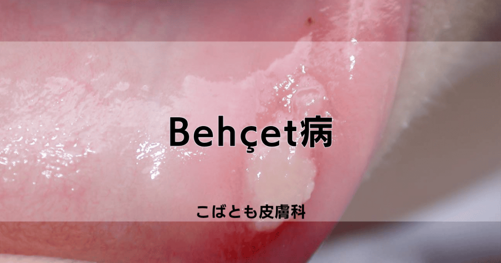 Behçet病