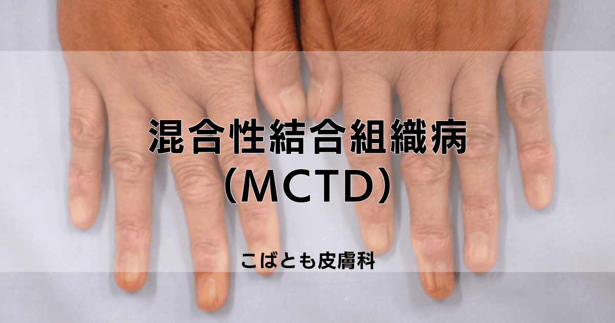 混合性結合組織病（MCTD）