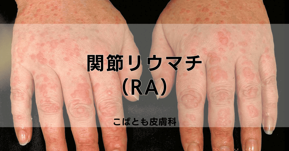 関節リウマチ（RA）