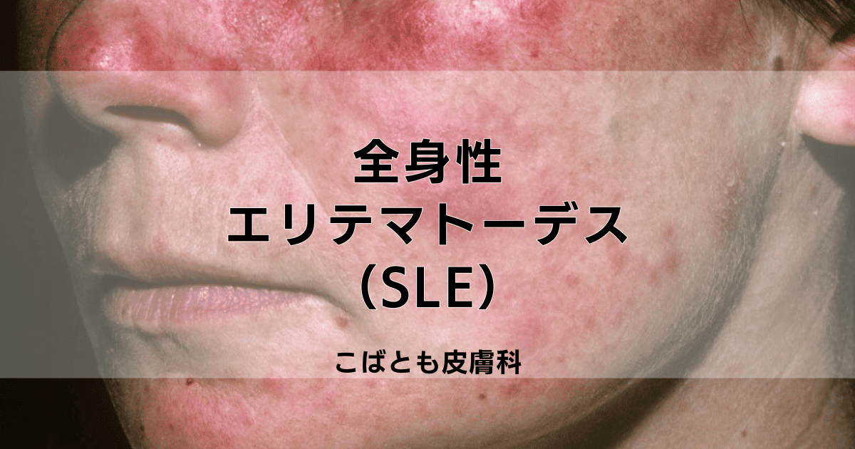 全身性エリテマトーデス（SLE）