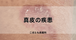 皮膚科の似たもの同士:目でみる鑑別診断 m3電子書籍 | Visual Dermatology 2024年臨時増刊号 Quizで鑑別