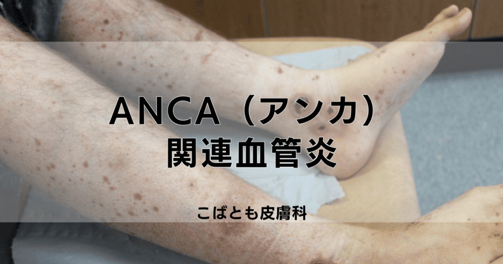 ANCA（アンカ）関連血管炎