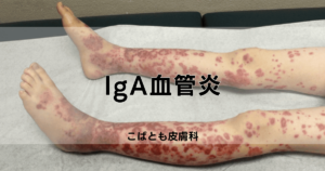 iga-vasculitis-title-300x158.png