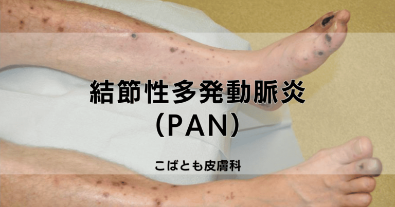 結節性多発動脈炎 (PAN)|こばとも皮膚科|栄駅(名古屋市栄区)徒歩2分