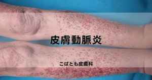 IgA血管炎（アナフィラクトイド紫斑病）｜こばとも皮膚科｜栄駅