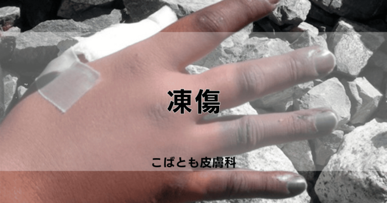 凍傷|こばとも皮膚科|栄駅(名古屋市栄区)徒歩2分
