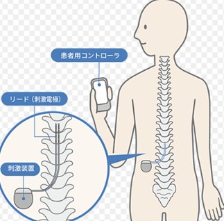 (図・文 一般社団法人 日本定位・機能神経外科学会参照)
