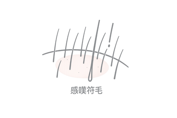 脱毛斑の縁に現れる感嘆符毛