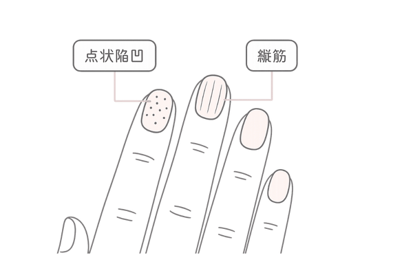 爪の点状陥凹や縦筋