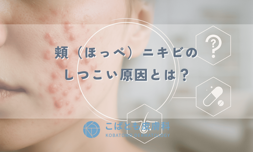 頬（ほっぺ）ニキビのしつこい原因とは？場所別の理由と効果的な治し方
