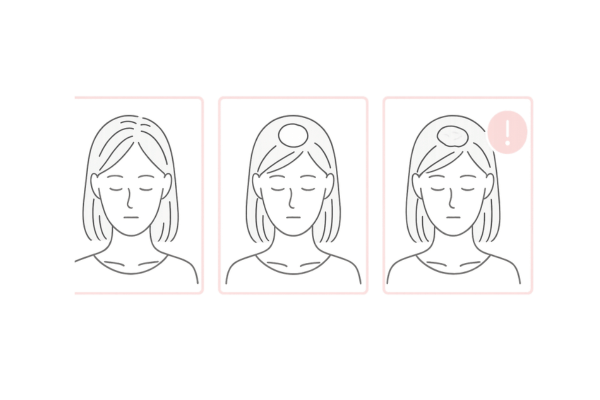 脱毛斑が広がる様子(進行イメージ)