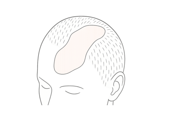 瘢痕性脱毛が広がる様子