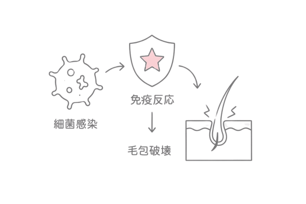 細菌感染や免疫異常などの複合的要因