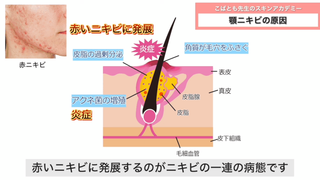 過剰な皮脂により顎ニキビができる仕組み