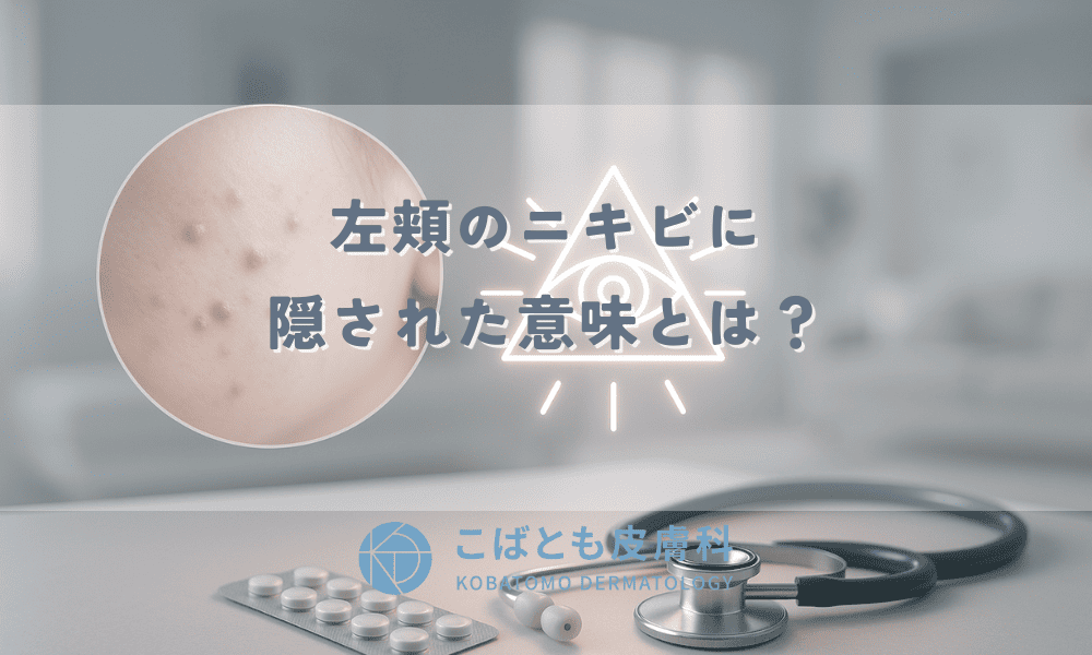 左頬のニキビに隠された意味とは？スピリチュアル？医学的な原因と対策
