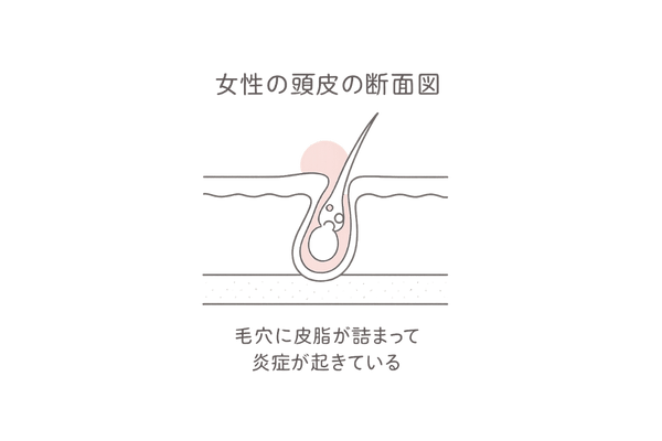 毛穴詰まりと炎症の仕組み