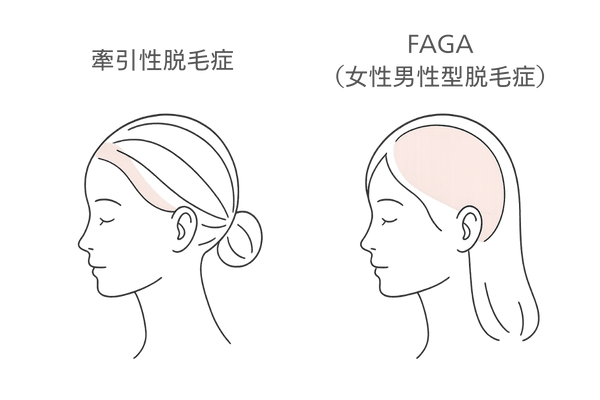 牽引性脱毛症とFAGAの違い