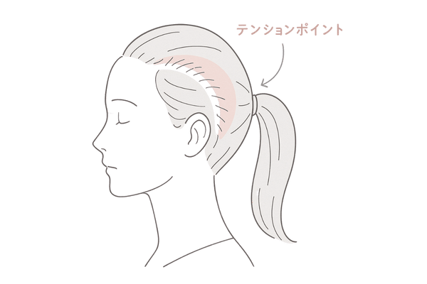 テンションポイント(円弧状脱毛)