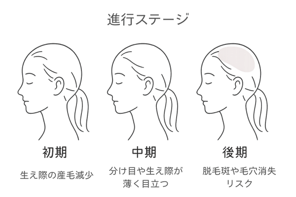ステージ別(初期・中期・後期)の牽引性脱毛症