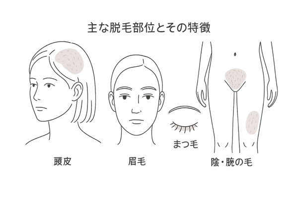 主な脱毛部位とその特徴