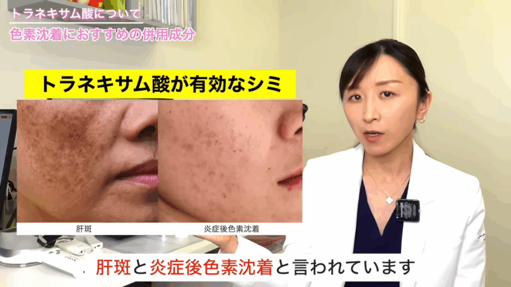 トラネキサム酸が有効なシミ