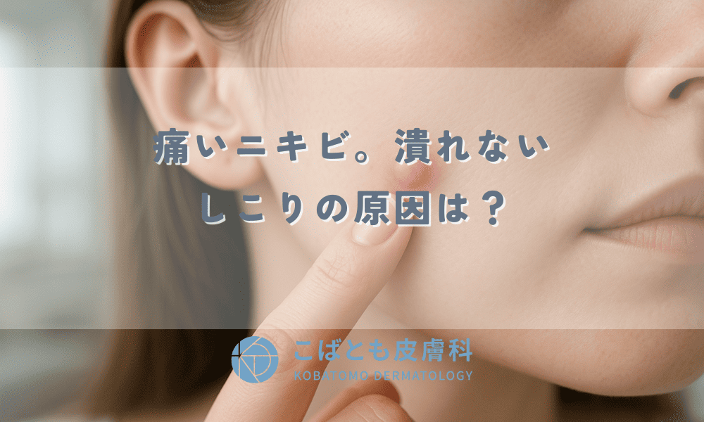 【痛いニキビ】潰れない「しこり」の原因は？絶対やってはいけないNGケアと跡を残さず治す方法