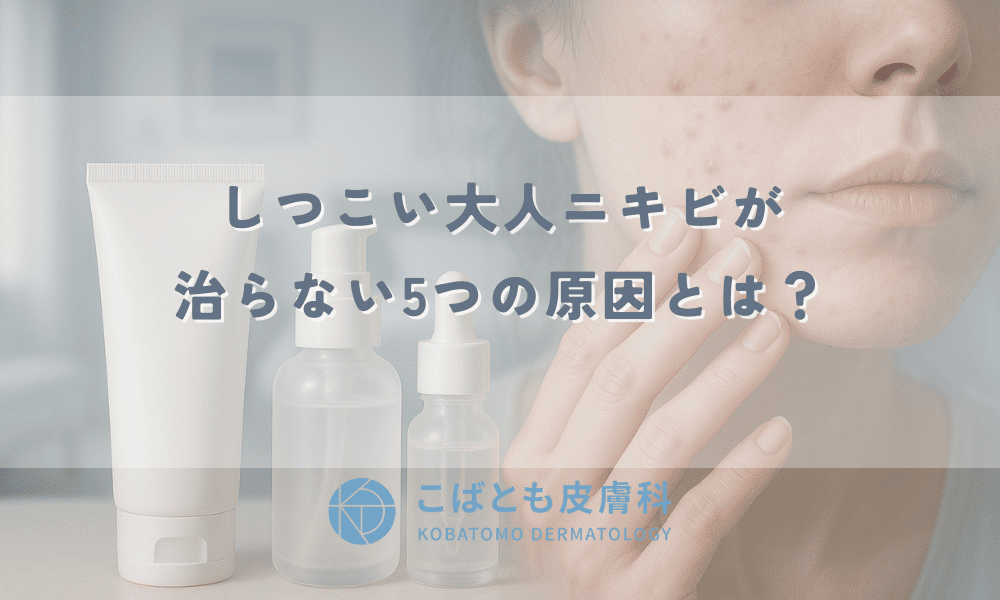 しつこい大人ニキビが治らない5つの原因とは？正しいスキンケアとNG習慣・皮膚科の治療法