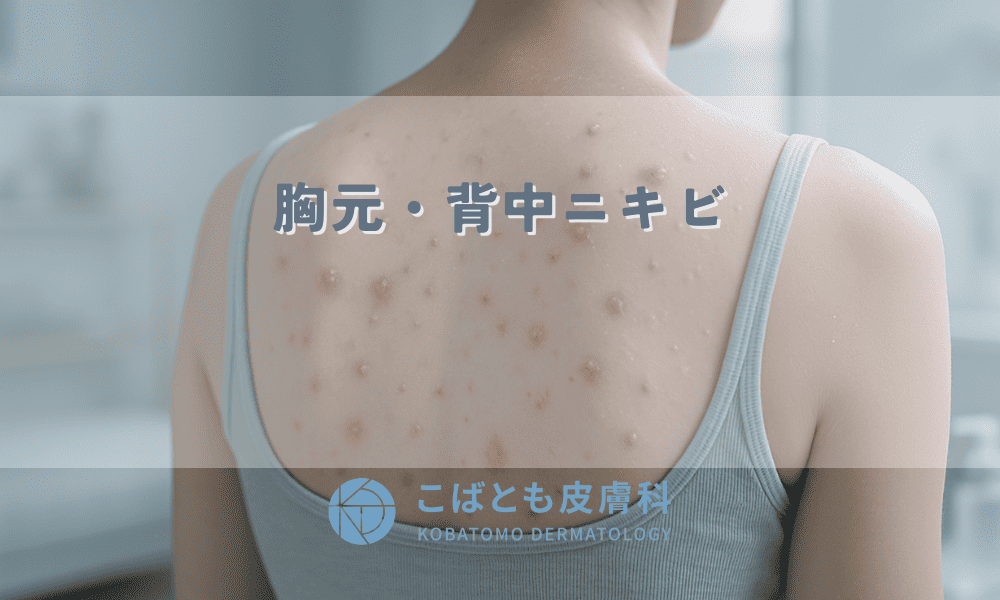 【胸元・背中ニキビ】原因は汗や服の摩擦？跡にしない治し方とつるつる肌を保つ予防ケア