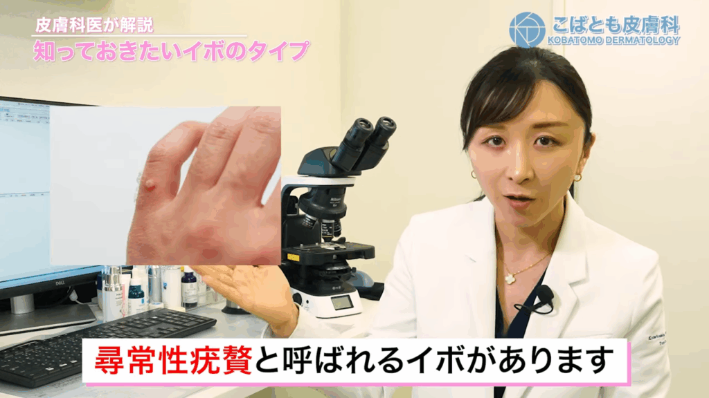 尋常性疣贅
