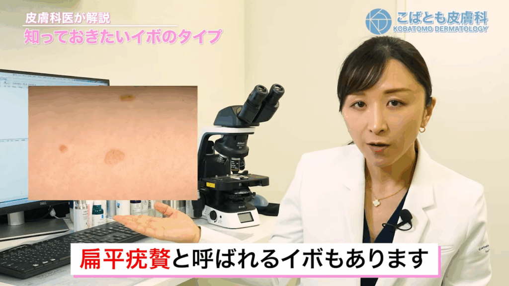 扁平疣贅