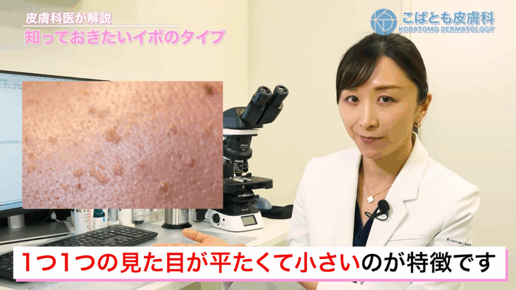扁平疣贅は1個1個の見た目が平たくて小さいのが特徴