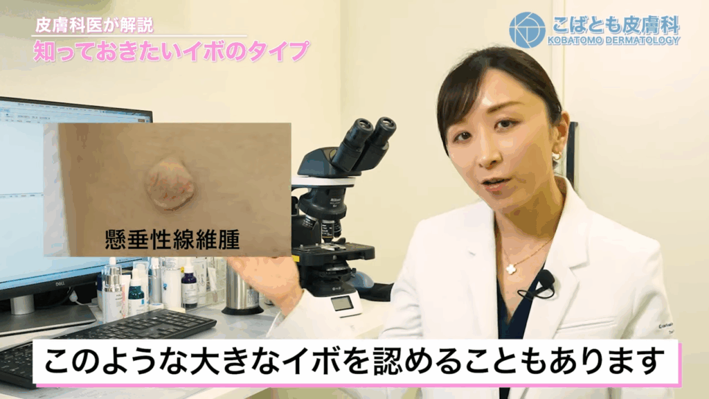 懸垂性線維腫