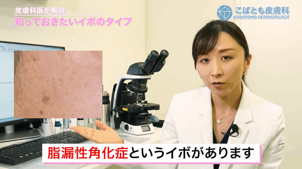 老人性イボ 脂漏性角化症
