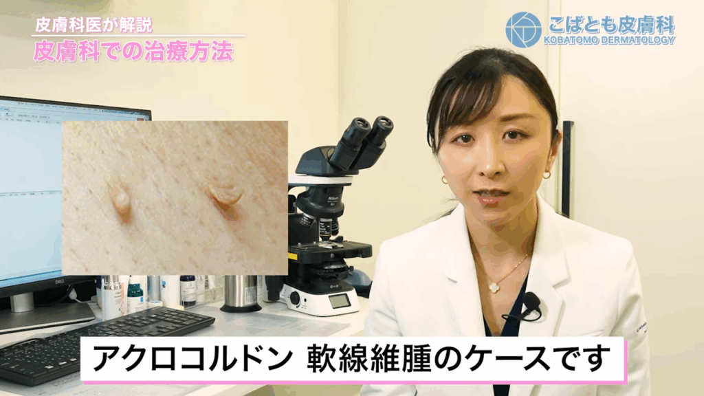 ハサミによる切除が有効なのは根元がくびれているアクロコルドン、軟性線維腫のケース