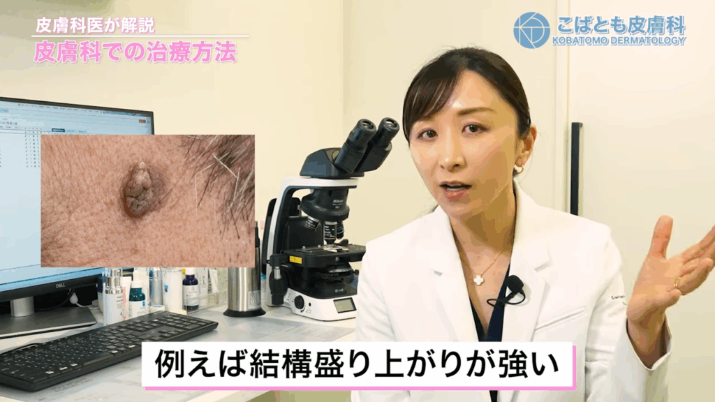 盛り上がりが強い脂漏性角化症