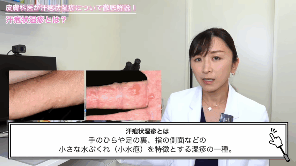 汗疱状湿疹の症状