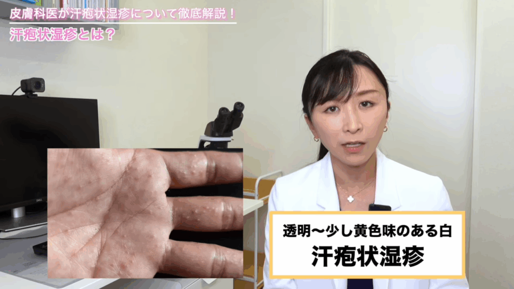 汗疱状湿疹