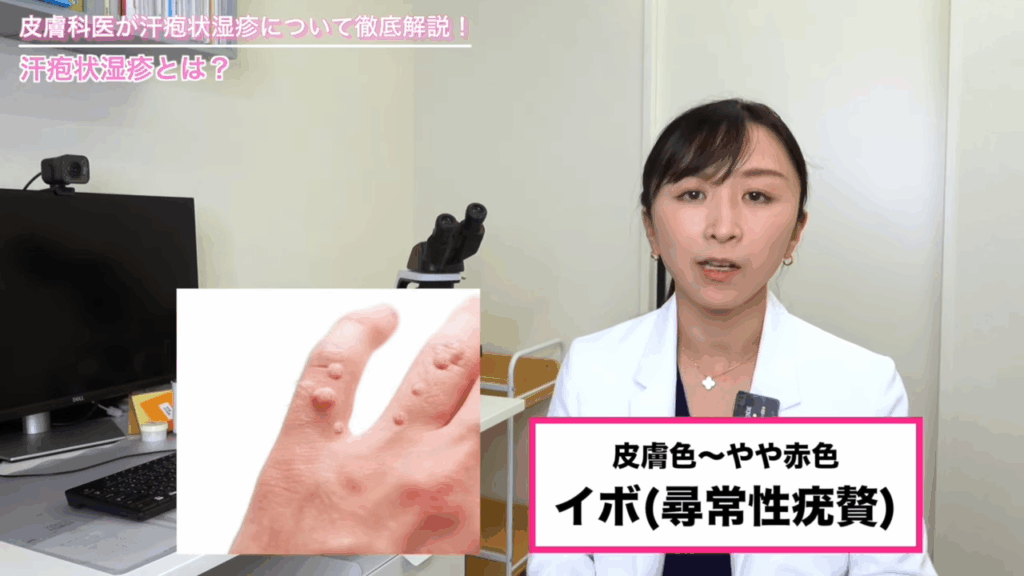イボ（尋常性疣贅）