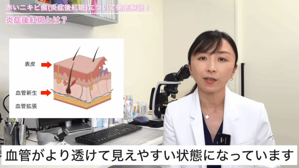 炎症後紅斑の所見
