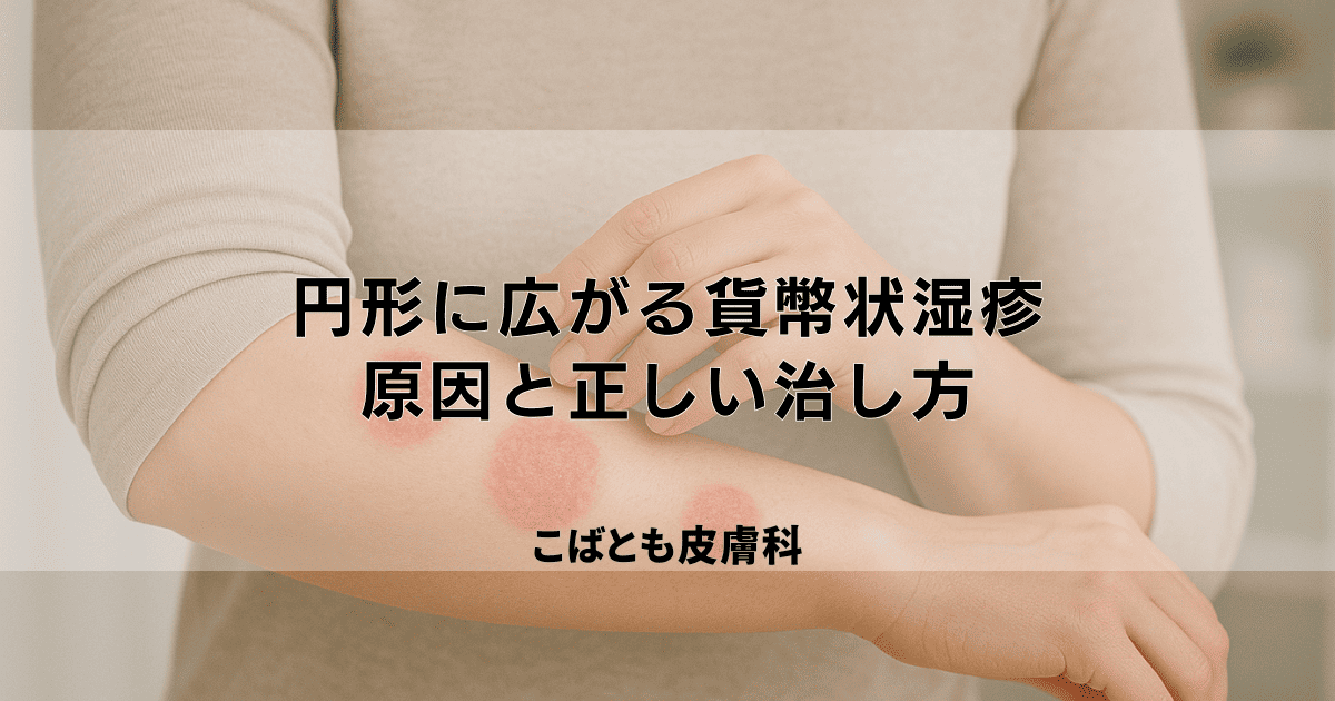 円形に広がる貨幣状湿疹の原因と正しい治し方｜繰り返さないための注意点