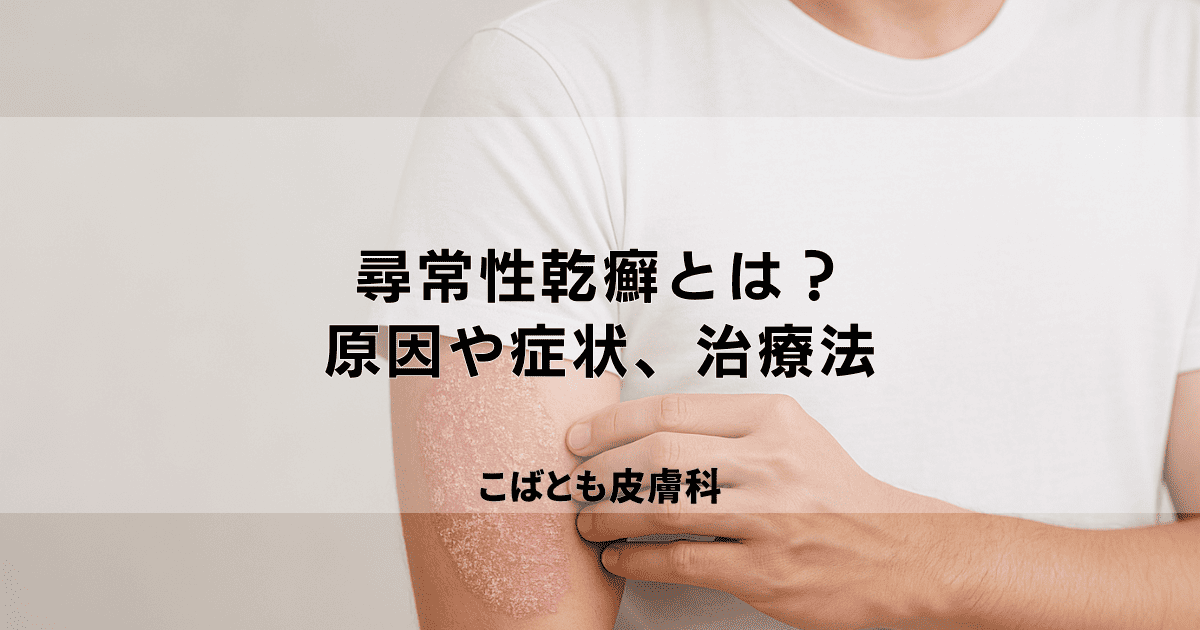 「尋常性乾癬（じんじょうせいかんせん）」とは？原因や症状、治療法を解説