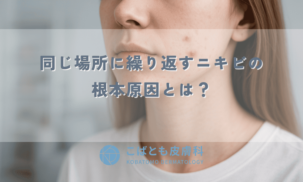 また同じ場所に…繰り返すニキビの根本原因とは？【場所別】に皮膚科医が治し方を解説